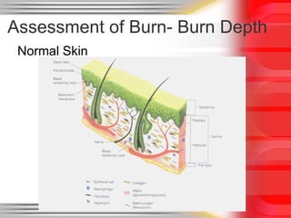 Normal Burn Pattern Skeleton Acute burn care ,basic to clinical by Dr iftikhar alam | PPTX