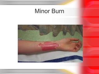 Minor Rug Burns Acute burn care ,basic to clinical by Dr iftikhar alam | PPTX