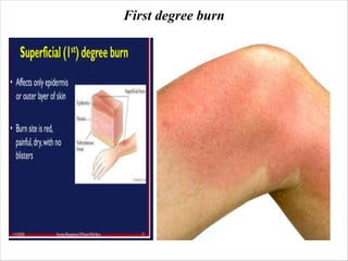 BURN management and first aid bsc nursing | PDF