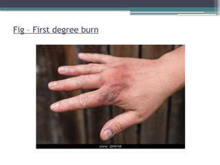 BURN types and physiotherapy management.pptx