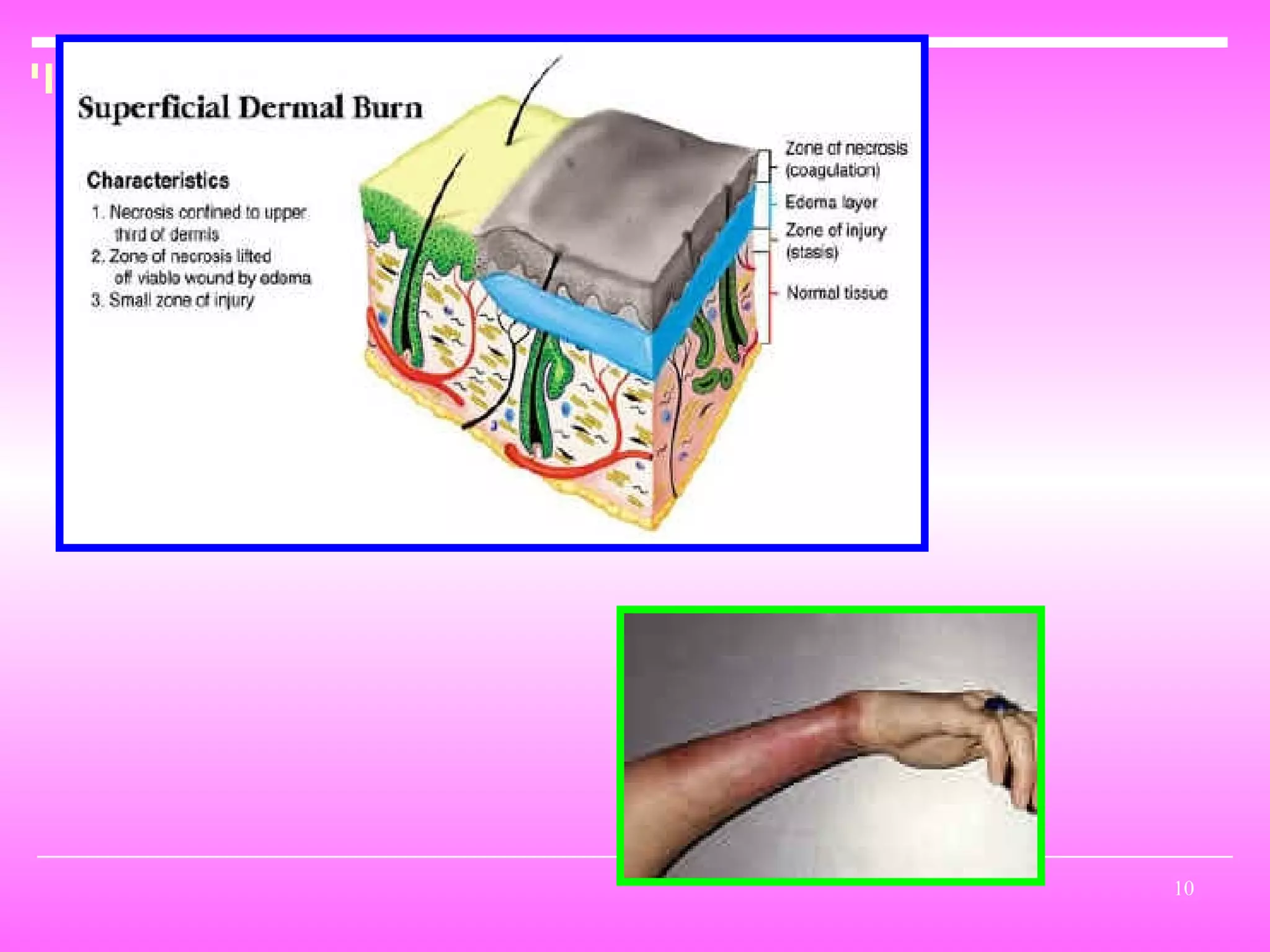 Burn And Scald | PPT