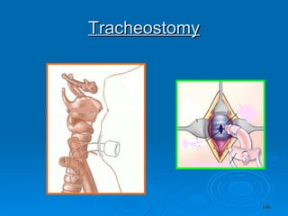 Tracheostomy 