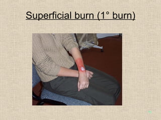 Superficial burn (1° burn) 