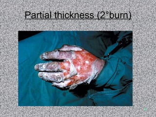 Partial thickness (2°burn) 