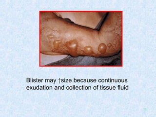 Blister may ↑size because continuous  exudation and collection of tissue fluid 