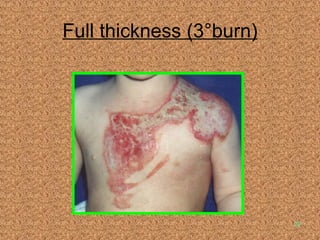 Full thickness (3°burn) 
