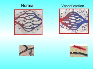 Normal Vasodilatation 