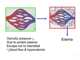 Edema Osmotic pressure ↓, Due to protein plasma Escape out to interstitial ↓ blood flow & hypovolemia 