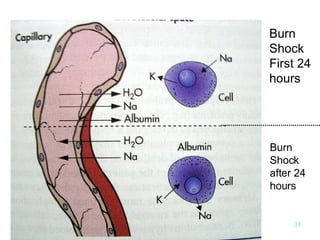 Burn  Shock  First 24 hours Burn  Shock  after 24 hours 