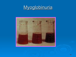 Myoglobinuria 