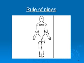 Rule of nines 