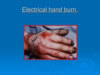 Electrical hand burn. 