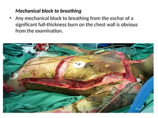 Mechanical block to breathing
• Any mechanical block to breathing from the eschar of a
significant full-thickness burn on the chest wall is obvious
from the examination.
 