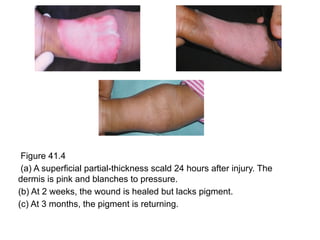 Figure 41.4
(a) A superficial partial-thickness scald 24 hours after injury. The
dermis is pink and blanches to pressure.
(b) At 2 weeks, the wound is healed but lacks pigment.
(c) At 3 months, the pigment is returning.
 