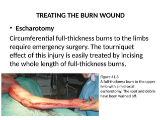 TREATING THE BURN WOUND
• Escharotomy
Circumferential full-thickness burns to the limbs
require emergency surgery. The tourniquet
effect of this injury is easily treated by incising
the whole length of full-thickness burns.
Figure 41.8
A full-thickness burn to the upper
limb with a mid-axial
escharotomy. The soot and debris
have been washed off.
 