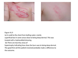 Figure 41.9
(a) A scald to the chest from boiling water, mainly
superficial but in some areas close to being deep dermal. This was
treated with a hydrocolloid dressing.
(b) There are two tiny areas of
hypertrophy indicating how close the burn was to being deep dermal.
The good first aid this patient received probably made a difference to
the outcome.
 