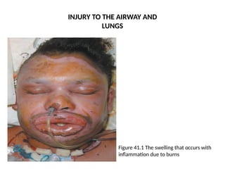 INJURY TO THE AIRWAY AND
LUNGS
Figure 41.1 The swelling that occurs with
inflammation due to burns
 