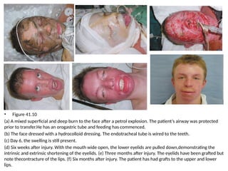 • Figure 41.10
(a) A mixed superficial and deep burn to the face after a petrol explosion. The patient’s airway was protected
prior to transfer.He has an orogastric tube and feeding has commenced.
(b) The face dressed with a hydrocolloid dressing. The endotracheal tube is wired to the teeth.
(c) Day 6, the swelling is still present.
(d) Six weeks after injury. With the mouth wide open, the lower eyelids are pulled down,demonstrating the
intrinsic and extrinsic shortening of the eyelids. (e) Three months after injury. The eyelids have been grafted but
note thecontracture of the lips. (f) Six months after injury. The patient has had grafts to the upper and lower
lips.
 