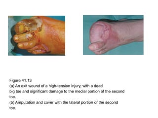 Figure 41.13
(a) An exit wound of a high-tension injury, with a dead
big toe and significant damage to the medial portion of the second
toe.
(b) Amputation and cover with the lateral portion of the second
toe.
 