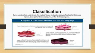 Classification
Burns are classified according to the depth of tissue destruction as superficial partial-thickness
injuries, deep partial-thickness injuries, or full-thickness injuries.
 