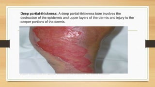 Deep partial-thickness. A deep partial-thickness burn involves the
destruction of the epidermis and upper layers of the dermis and injury to the
deeper portions of the dermis.
 