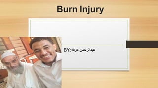 Burn Injury
BY ‫عرفه‬ ‫عبدالرحمن‬
:
 