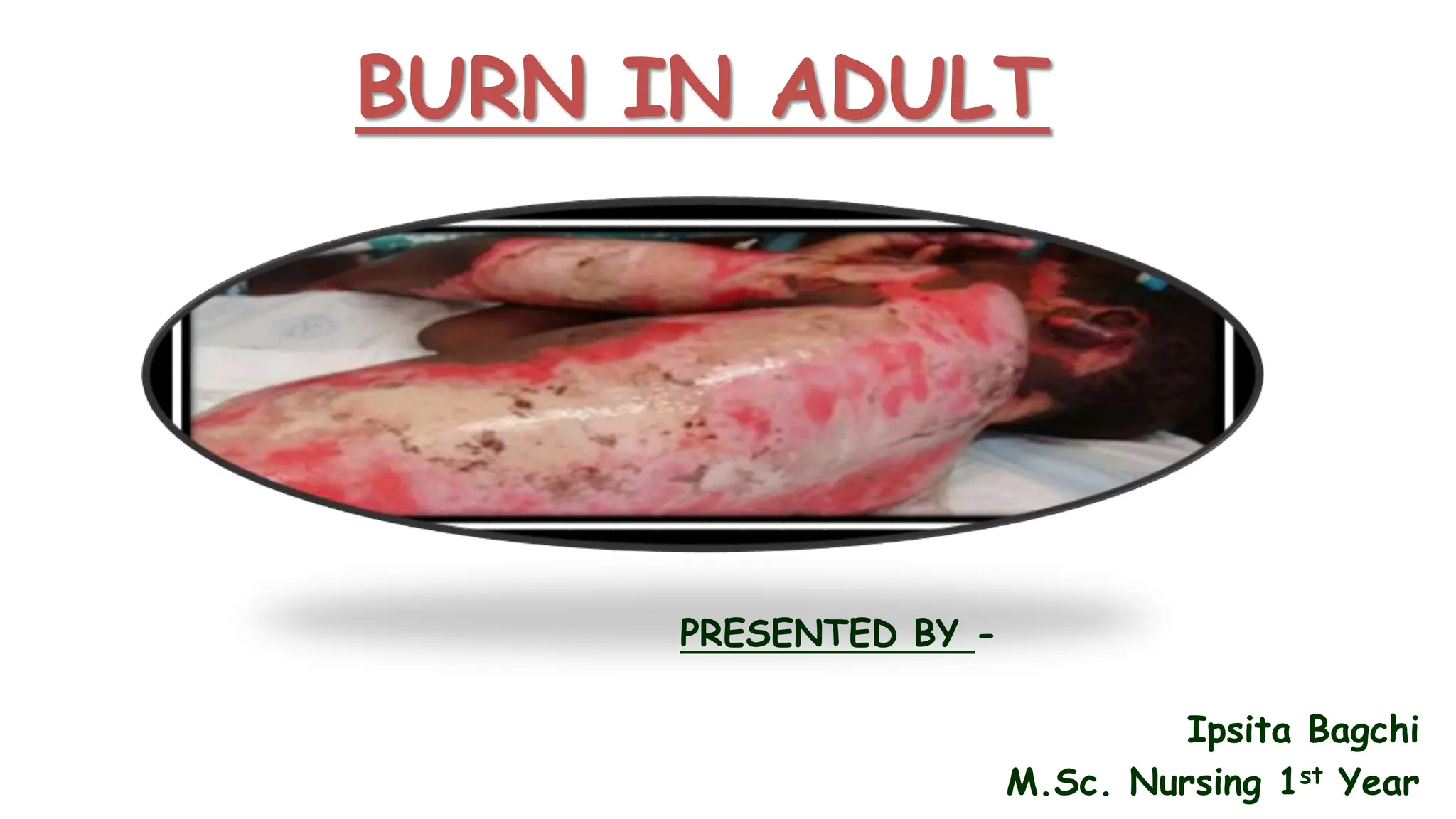 BURN IN ADULT
PRESENTED BY -
Ipsita Bagchi
M.Sc. Nursing 1st Year
 
