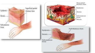 BURN details types and definition and all | PPTX