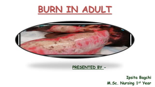 BURN IN ADULT
PRESENTED BY -
Ipsita Bagchi
M.Sc. Nursing 1st Year
 