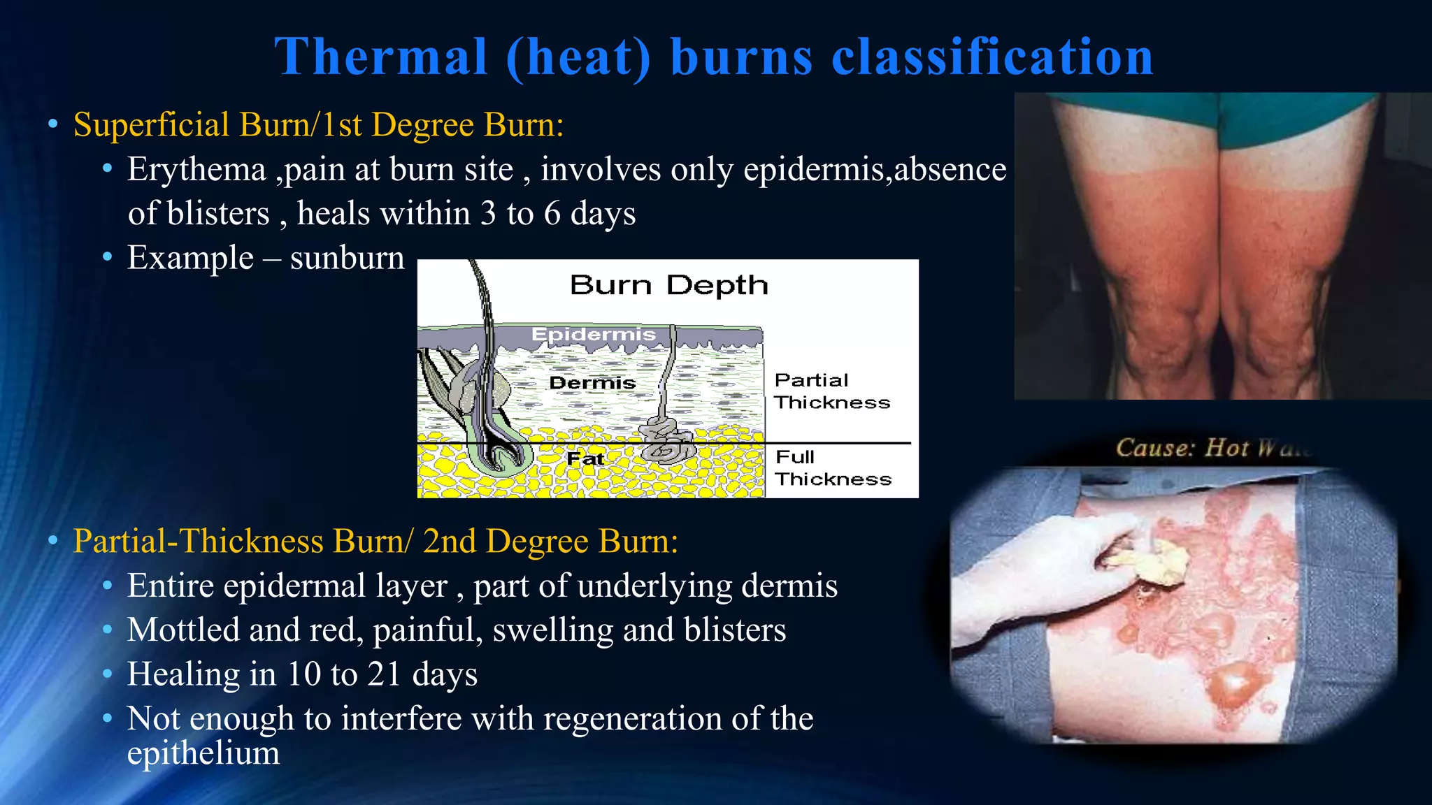 Burn and anaesthesia | PPTX