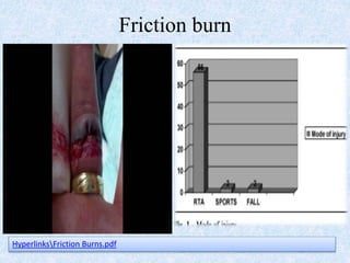 Hand Rope Friction Burn Burn and Burn Rehabilitation.pptx.ppt