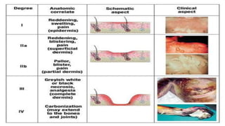 Burn classification | PPTX