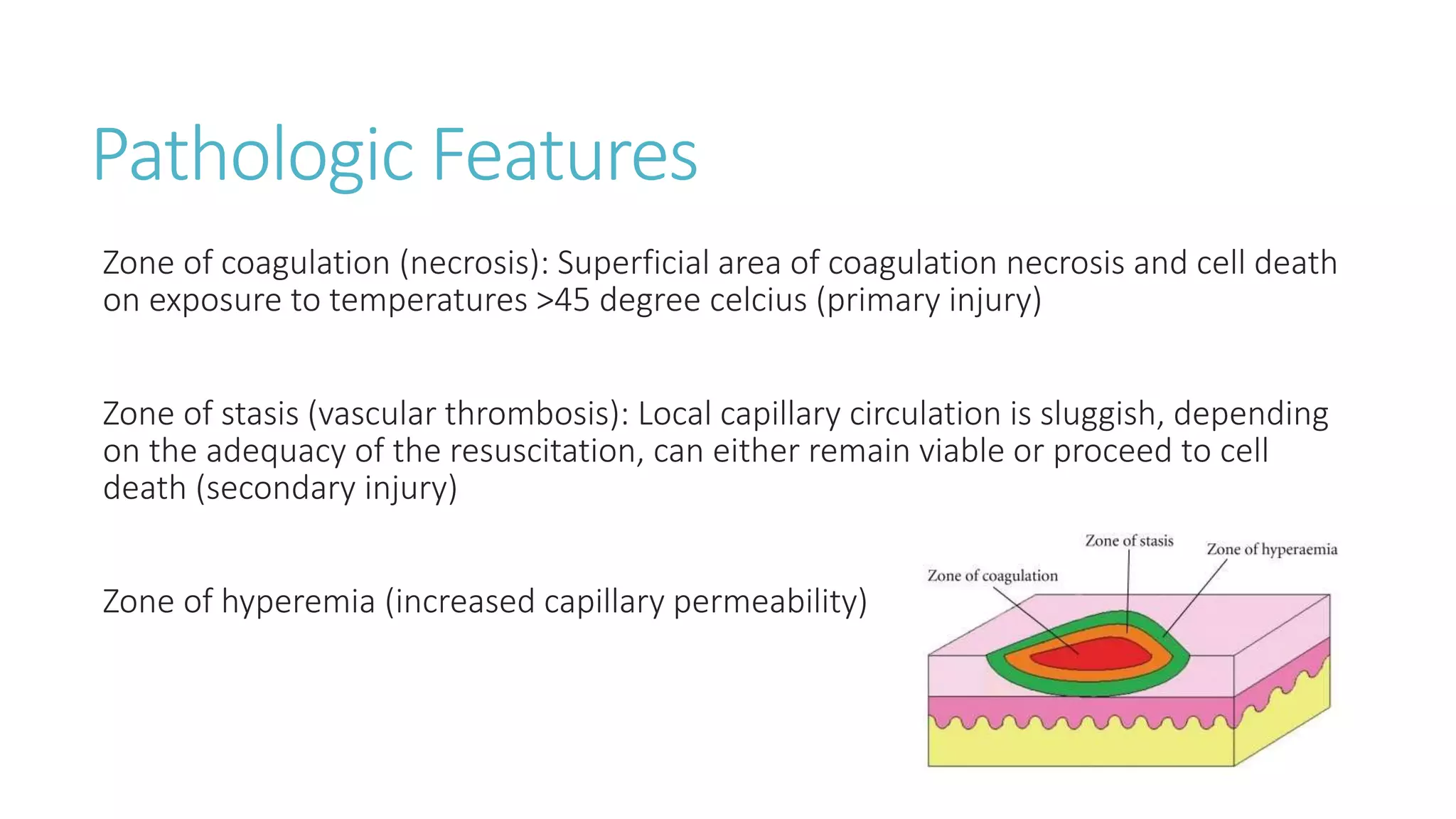 Pathologic Features
Zone of coagulation (necrosis): Superficial area of coagulation necrosis and cell death
on exposure to temperatures >45 degree celcius (primary injury)
Zone of stasis (vascular thrombosis): Local capillary circulation is sluggish, depending
on the adequacy of the resuscitation, can either remain viable or proceed to cell
death (secondary injury)
Zone of hyperemia (increased capillary permeability)
 