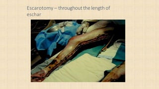 Burn CME .pptx