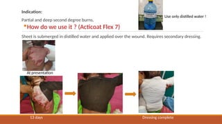 Burn dressings FOR VARIUOUS DEFECTS OF IT | PPTX