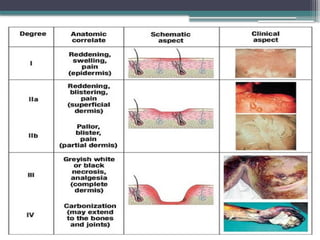BURN management classification treatment | PPT