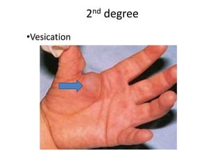 Vesication Burn(dry heat) | PPTX