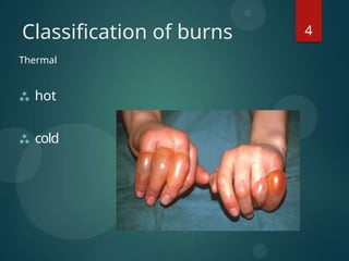 BURN HISTORY,PHYSICAL EXAMINATION OF BURN & PATHOPHYSIOLOGY.pptx