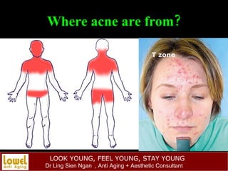 Where acne are from? T zone 