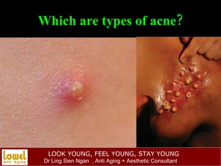 Which are types of acne? 