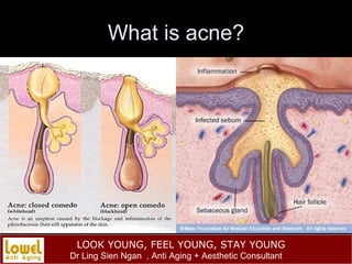 What is acne? 