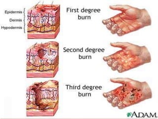 Burn Injuries.ppt