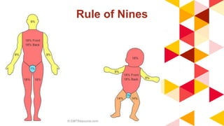 Rule of Nines
 