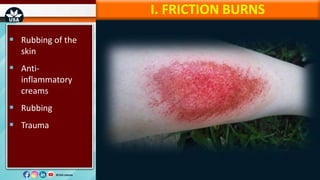 Bad Rug Burn Burn injuries, classification and management | PPTX