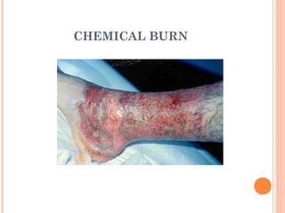 CHEMICAL BURN




                4
 