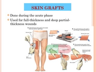 SKIN GRAFTS
 Done during the acute phase
 Used for full-thickness and deep partial-
  thickness wounds




                                          42
 