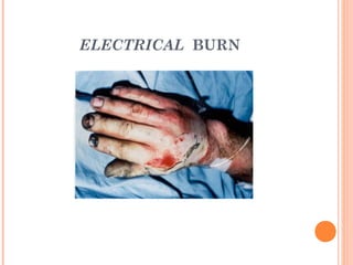 ELECTRICAL BURN




                  5
 