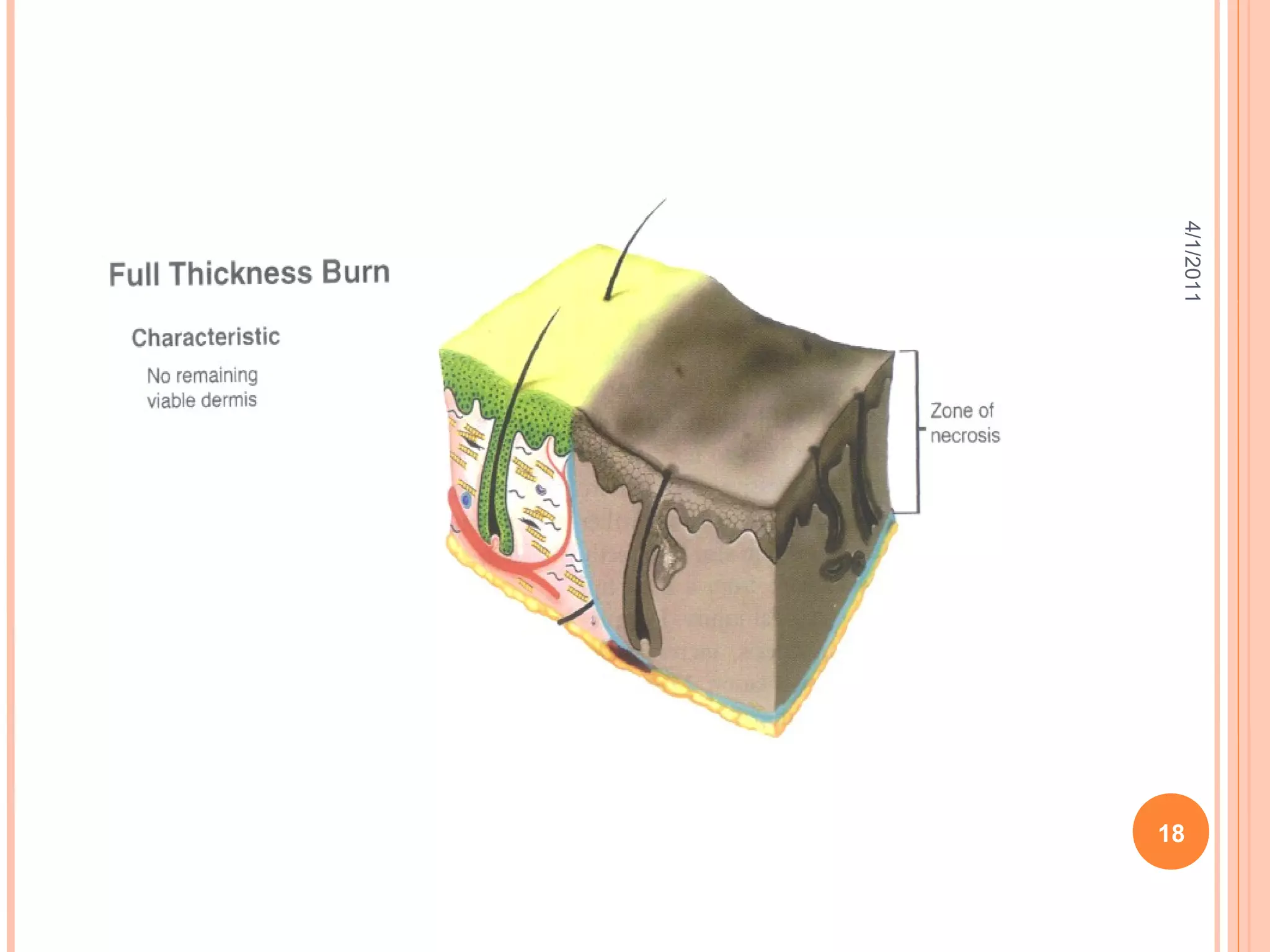 Burn Injuries and Its Management | PPT