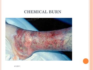 CHEMICAL BURN
4/1/2011 5
 