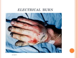 ELECTRICAL BURN
4/1/2011 6
 